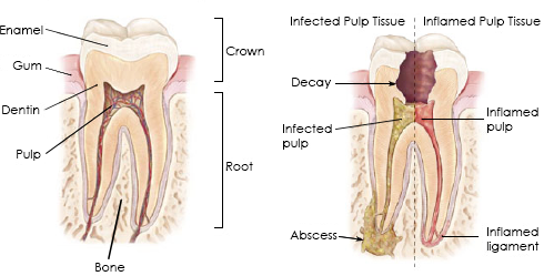 How would I know I need a root canal?