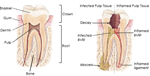 how-root-canal